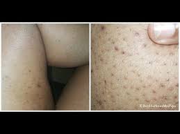 Black Pesky Spots On The Skin Are Often A Beauty Problem They Can Stand Out Become Itchy And Diff Inner Thigh Pimples Body Pimples How To Treat Blackheads