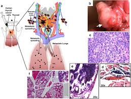 I am 33 years old and i have just learned that my papillary thyroid cancer spread to my lungs. Orthotopic Mouse Models For The Preclinical And Translational Study Of Targeted Therapies Against Metastatic Human Thyroid Carcinoma With Brafv600e Or Wild Type Braf Oncogene