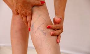 Poor circulation in legs pictures. Dangers Of Poor Blood Circulation