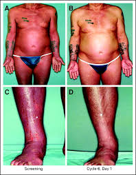 Image result for Romidepsin