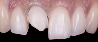 Kirsten ramsay ceramic conse rvation and restoration is an established business based in the united kingdom. Restoration Of A Central Incisor Direct Composite Vs Ceramic Veneer Styleitaliano Org