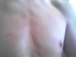 Datei Pickel Brust Jpg Wikipedia