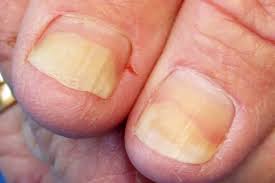 Image result for Pitting nails feet