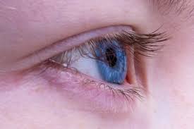 The first thing that needs to be done in the management of eyelids dermatitis is to identify the substance causing inflammatory symptoms. Swollen And Inflamed Eyelid Blepharitis Treating It With Plants