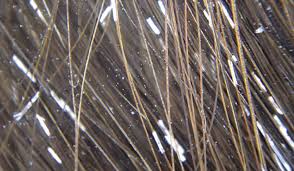 White piedra (wp) is an asymptomatic superficial mycosis that affects the hair stems, forming whitish nodules caused by various species of the genus trichosporon. Pseudonits Definition Causes Symptoms Diagnosis Treatment