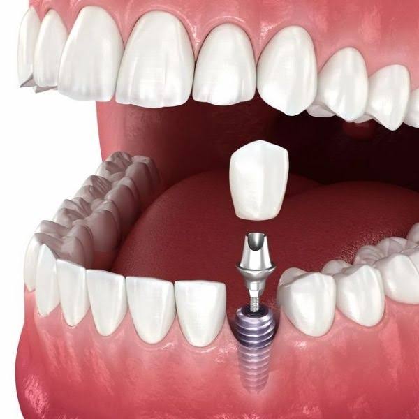 Dental Implants Treatment in Pashan, Pune product image