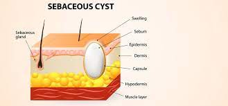 14 Home Remedies To Treat Sebaceous Cysts Home Remedies For Cysts Home Remedies Cysts