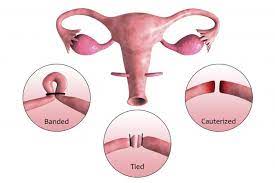 The Odds Of Getting Pregnant After Your Tubes Are Tied Lovetoknow
