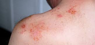 Image result for shingles