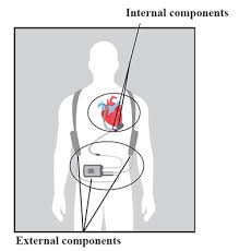 An lvad is a pump that is installed in parallel with the left ventricle, to receive the oxygenated blood returning from the lungs and pump it through the body. Left Ventricular Assist Devices Lvad