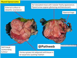 Image result for Liposarcoma
