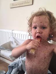 Tot was hospitalised for five days after getting the worst chicken pox  doctors had ever seen