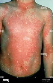 Image result for Scarlet Fever