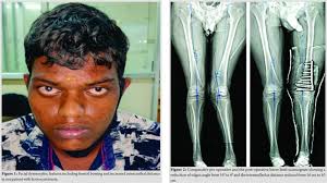 Image result for Homocystinuria