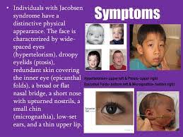Flat nasal bridge and epicanthal folds / fetal alcohol syndrome yo'll ever stroke your philtrum. Jacobsen Syndrome Samarpan Physiotherapy Clinic Ahmedabad