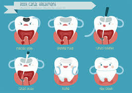 If it's a typical filling that you need, your dentist has likely had a lot of practice and can get the procedure done within an hour. Visit A Root Canal Dentist To Have An Infection Removed Carolina Smiles Family Dental Brevard North Carolina