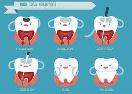 Check spelling or type a new query. Signs An Emergency Root Canal Is Necessary