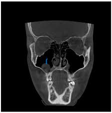 Image result for Sinus CT