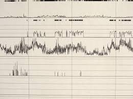 obstructive sleep apnea increases cardiac remodeling in