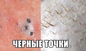 рецепт маски от черных точек с желатином и активированным углем Udalenie Chernyh Tochek Rabotayushij Metod Pochitajte Chernye Tochki Udalenie Chernil Zhelatinovaya Maska Dlya Lica