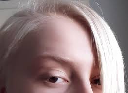 Patience is the key ingredient to any journey, especially this one. I Have White Hair And Dark Brown Eyes Albino Father And Brown Eyed Mother Goodrisingtweets