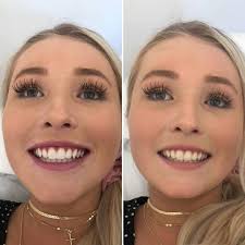 Ultraglow Teeth Whitening