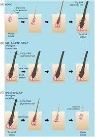Scalp hair loss is often a major concern for transgender women and transfeminine people. Androgens And Hair A Biological Paradox With Clinical Consequences Chapter 7 Testosterone