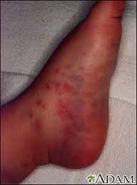 This can create purple spots on the skin that range in size from small dots to large patches. Purpura Information Mount Sinai New York