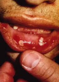 Image result for Canker sores symptoms roof of the mouth