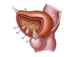 Image result for Bladder Cancer