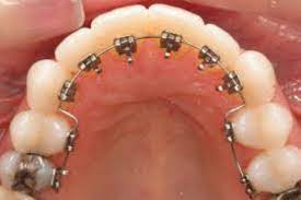 Adult braces are becoming more and more popular, and along with this demand there has been some great innovation in the materials and technology used in orthodontic treatment. Lingual Braces Manchester Orthodontics