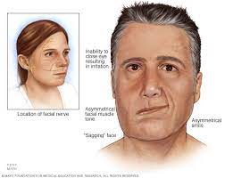 Signs and symptoms of bell's palsy. Bell S Palsy Symptoms And Causes Mayo Clinic
