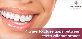 Find out during your appointment. 4 Ways To Close Gaps Between Teeth Without Braces