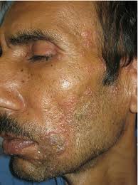 I've scheduled an appointment with a dermatologist, but that's two weeks down the road. Herpes Zoster On The Face In The Elderly Bmj Case Reports