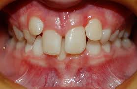 「" 	 crowding」的圖片搜尋結果