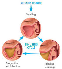 Image result for Sinusitis Prediction Rule