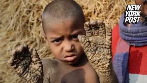 This 8-year-old boy's skin looks like it's turning to stone