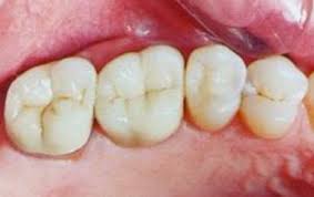 Maybe you would like to learn more about one of these? Dental Filling And Tooth Cavity Filling Cost Treatment Causes
