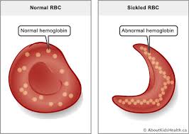 Diagram comparing a normal red blood cell with normal hemoglobin to a sickled RBC with abnormal hemoglobin chains
