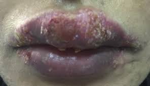 So after tattooing the chanc. Cosmetic Lip Tattoo Sequelae A Case Report And Review Of Literature Sciencedirect