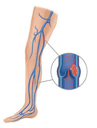Reemplazo Total De Rodilla Total Knee Replacement Orthoinfo Aaos In 2020 Vein Thrombosis Knee Replacement Deep Vein Thrombosis
