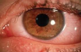 Image result for Allergic Conjunctivitis