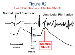 Image result for Electrical Injury