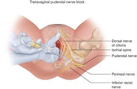 Image result for Pudendal Block