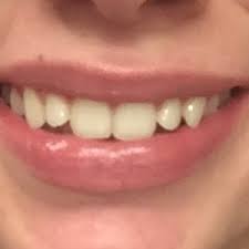 It's not as uncommon as you might think. What Is The Best Treatment To Fix A Crooked Smile How Many Units Would It Take And About How Much Would It Cost Photo