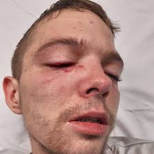 A disabled man was left with possible brain injuries after being beaten up  with a rubber hammer