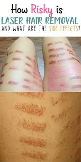 I'm a woman and much conscious about the breast cancer matter though we don't have medical history of it. How Risky Is Laser Hair Removal What Are The Side Effects Laser Hair Removal Laser Hair Electrolysis Hair Removal