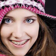 Http Www Aboutbraces Com Au Orthodontic Braces Type A Total Tooth Moving System Which Can Result In Amazing Adjustments To Braces Girls Braces Orthodontics