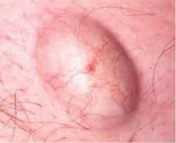 The truth is sometimes they are insignificant, but they are certainly annoying — and if left uncared for they can turn into a much bigger problem. Everything You Need To Know About Wax And Sugar Skin Reactions Sugar Me Wax