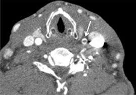 Carotid artery dissection is a relatively uncommon entity that results from either traumatic injury or can be spontaneous without a clear etiology. Asymptomatic Traumatic Common Carotid Artery Dissection Sciencedirect